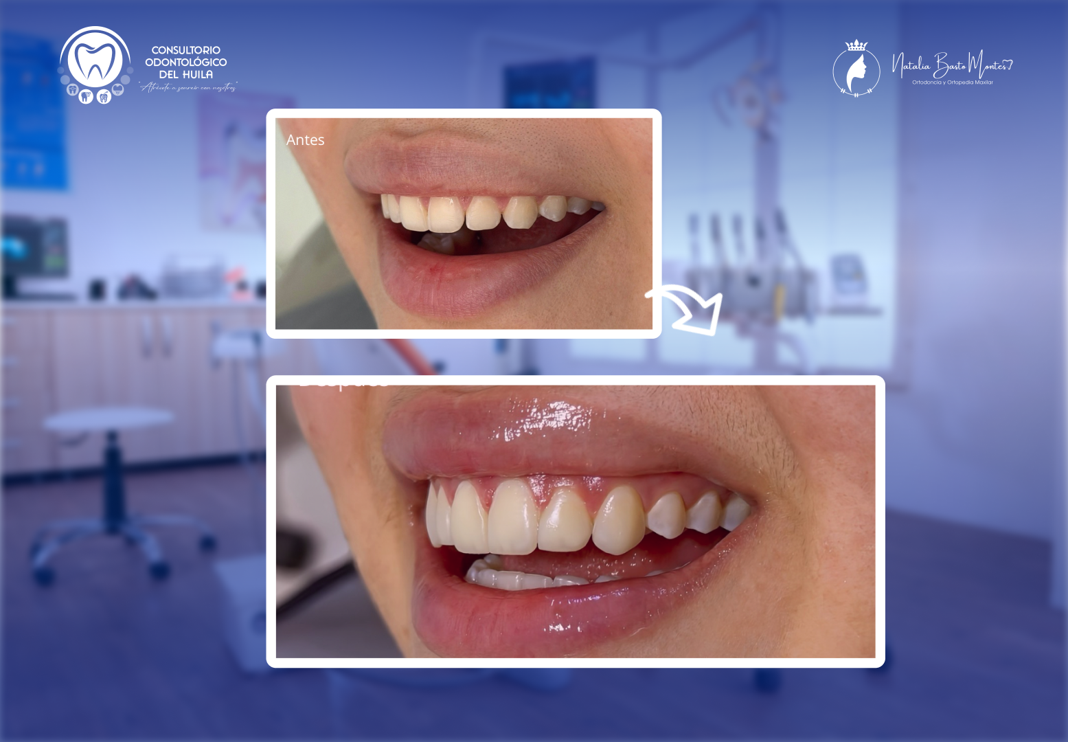 Caso de éxito: Bordes Estéticos Estratificados en Resina
