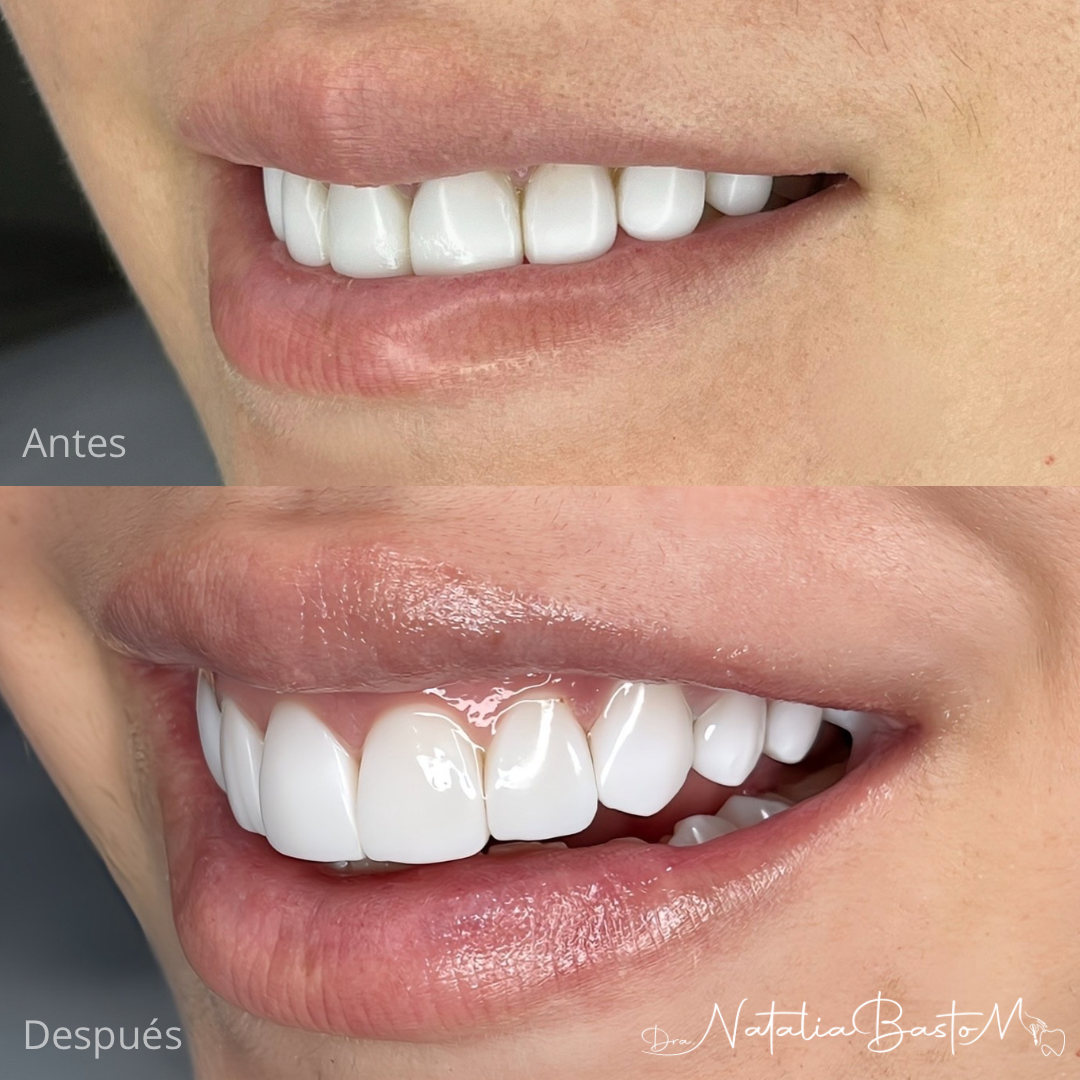 Renovación de Diseño de Sonrisa con Carillas en Resina: Un Caso de Éxito