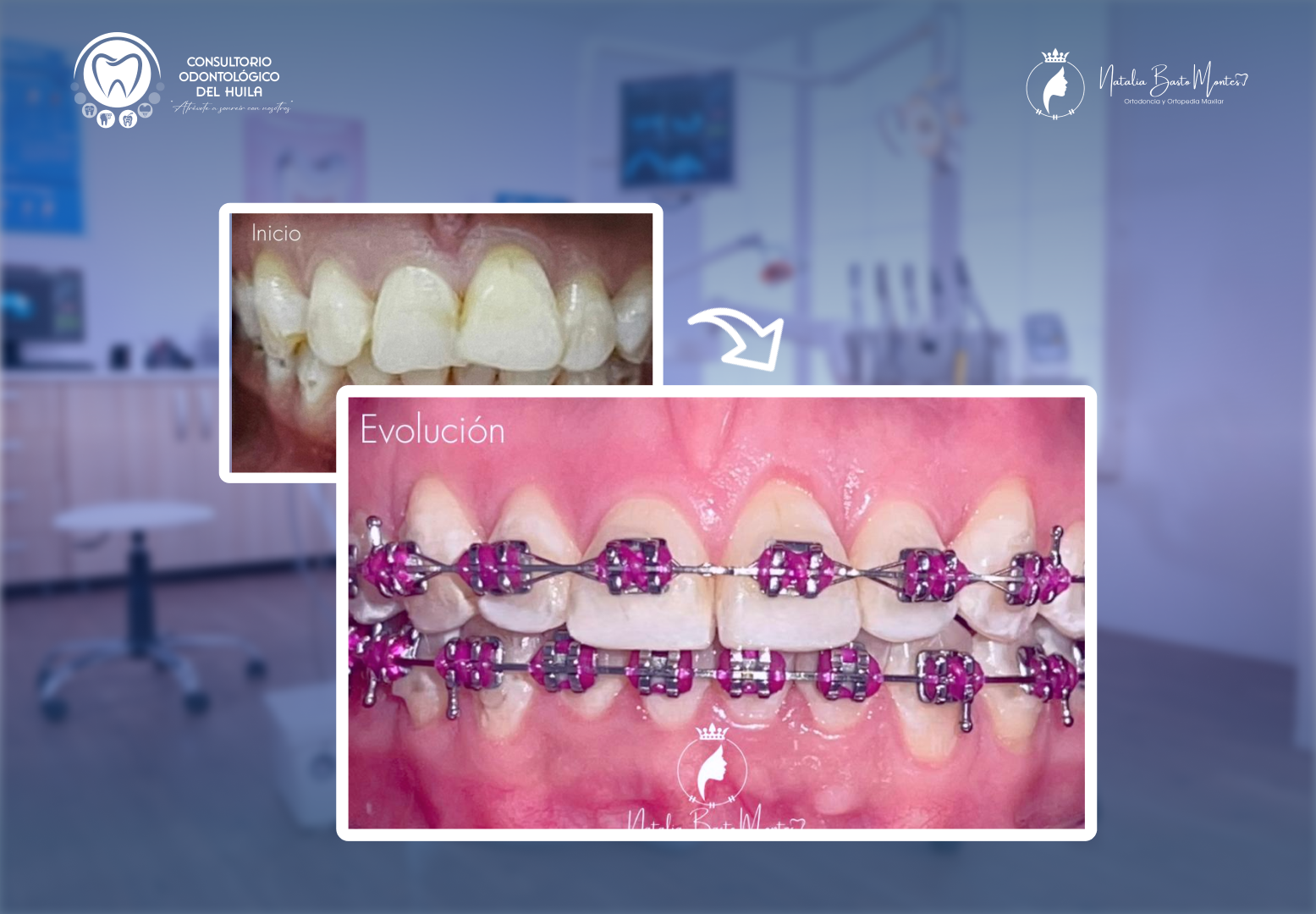 Evolución de Sonrisa: Tratamiento de Fluorosis y Ortodoncia en Proceso