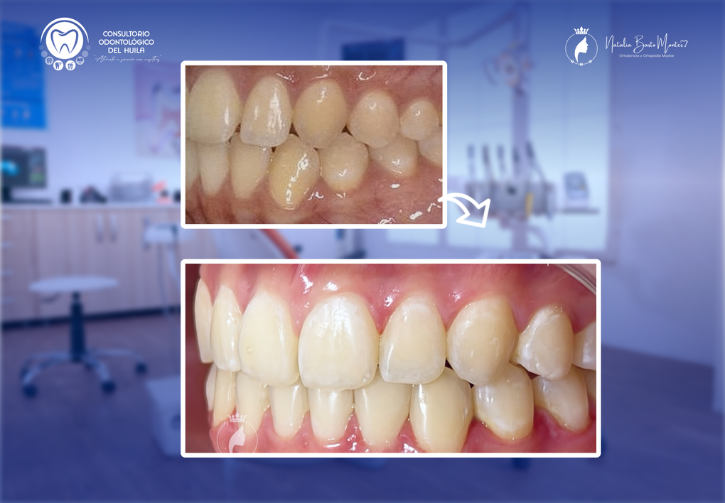 Caso de Éxito: Ortodoncia con Brackets Metálicos en un año