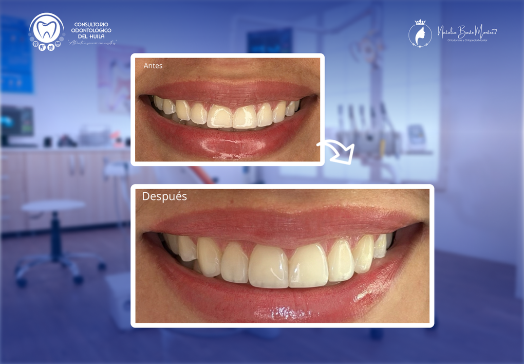 Caso de éxito: Bordes Estéticos Estratificados en Resina