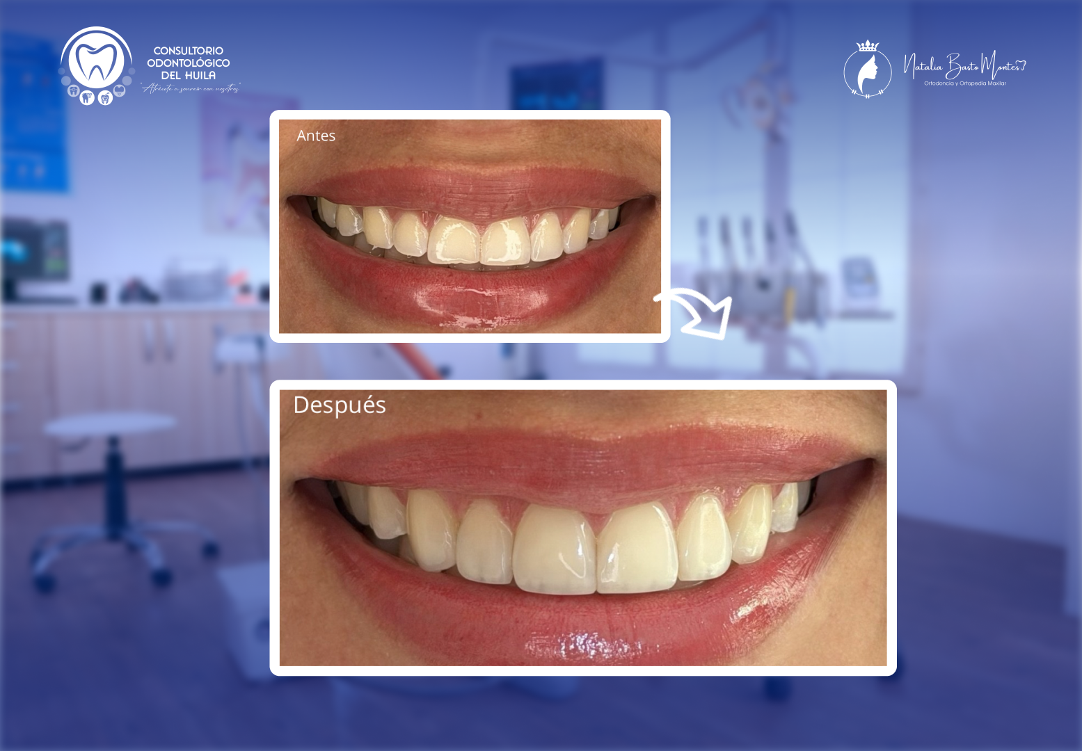 Caso de éxito: Bordes Estéticos Estratificados en Resina
