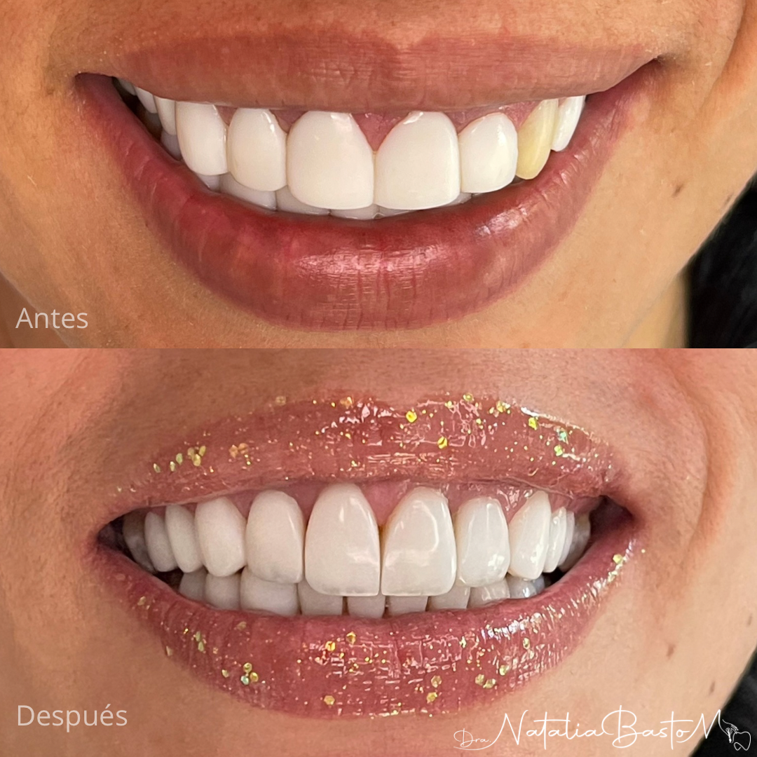 Mejoramos la sonrisa de nuestra paciente con resinas de alta estética dental
