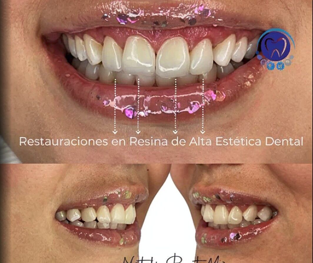 Rediseñamos su sonrisa con resinas… y el resultado fue espectacular