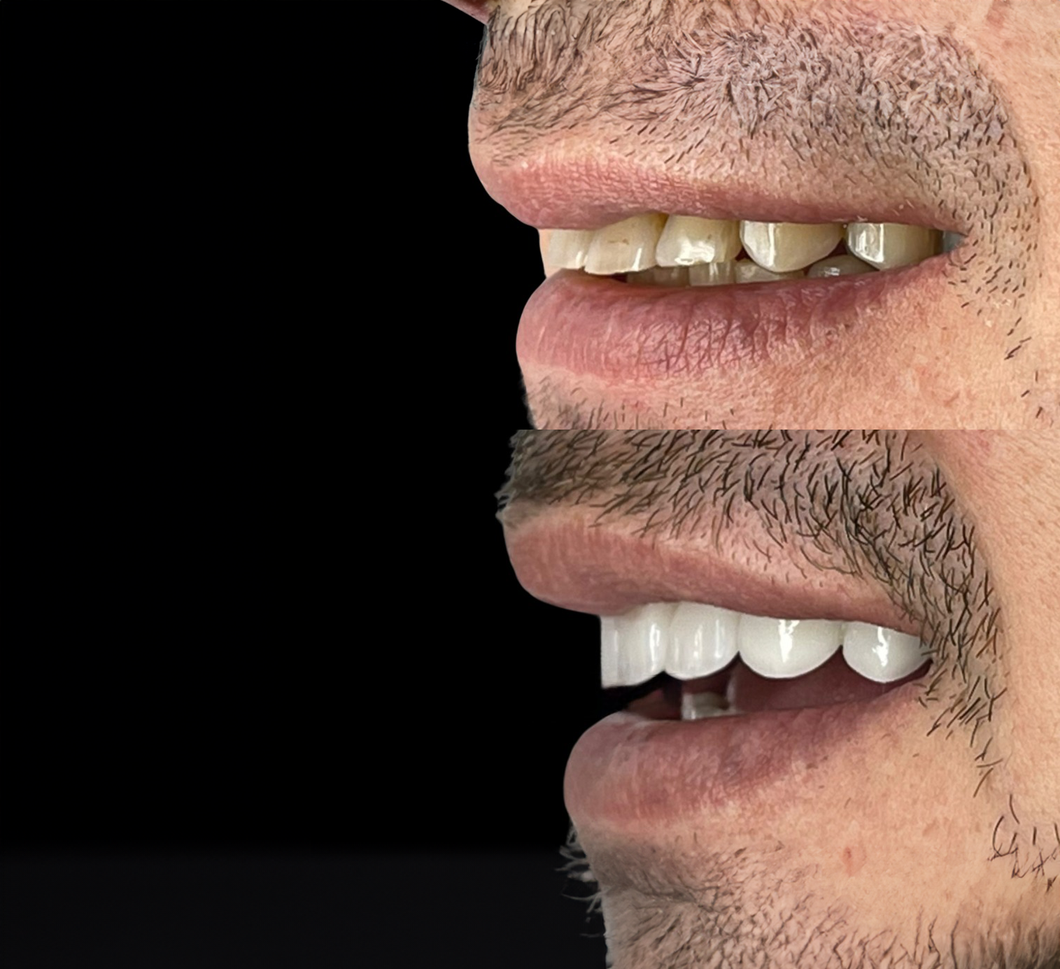 Un excelente cambio en Dientes Desalineados e inclinados en nuestro Paciente