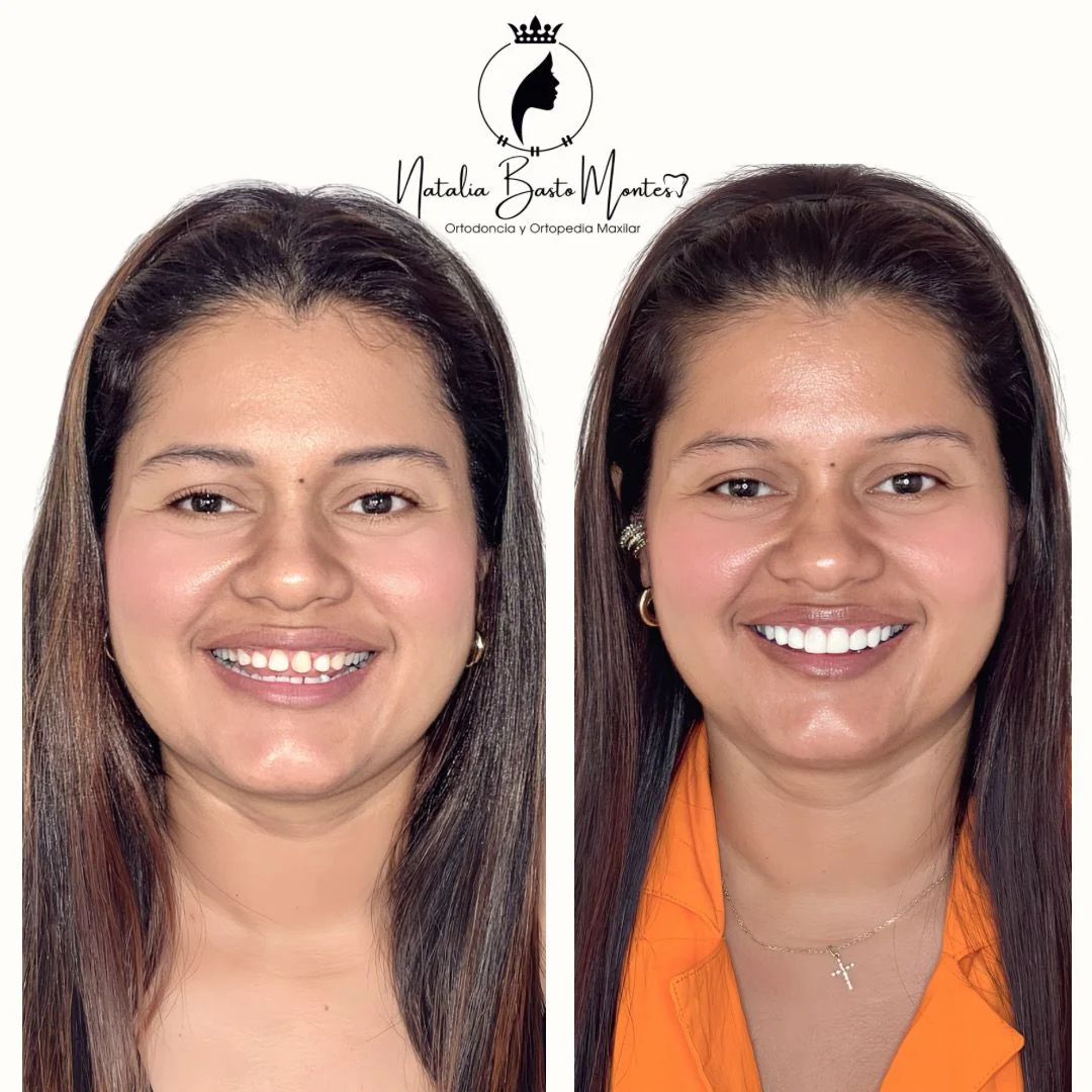 !Un Cambio de Sonrisa Sin Desgaste Dental!