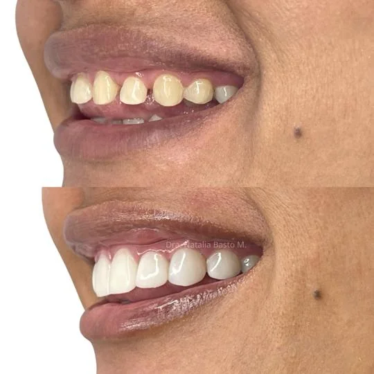 !Un Cambio de Sonrisa Sin Desgaste Dental!