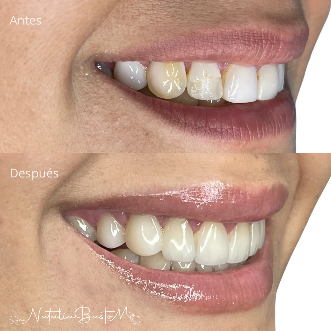 Una Sonrisa Brillante con Carillas de Resina Directa