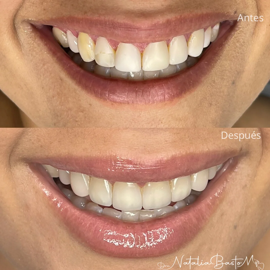 Una Sonrisa Brillante con Carillas de Resina Directa