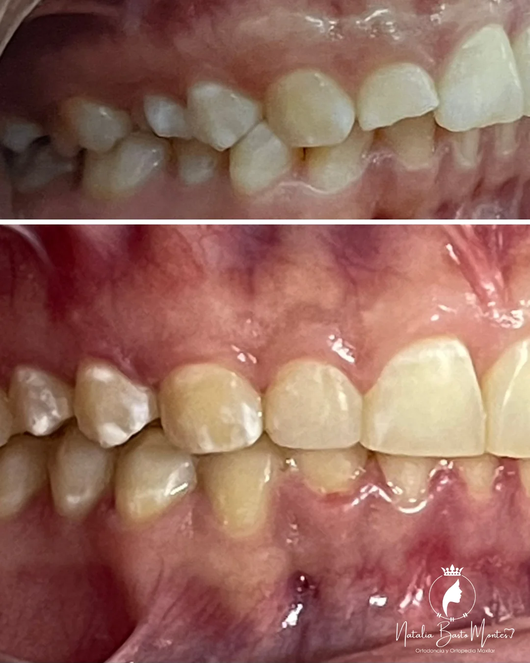 Ortodoncia de Brackets Metálicos con Resultados Estéticos y Funcionales