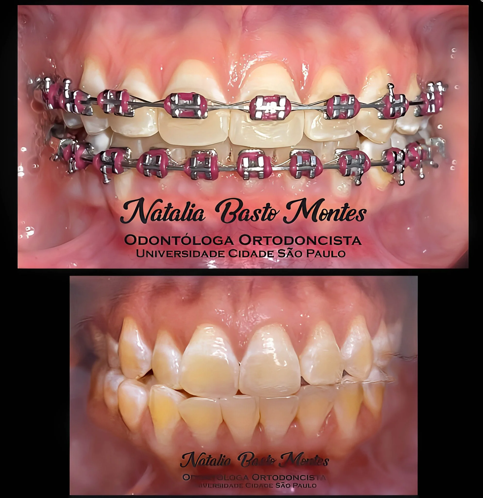 Corrigiendo Dientes inclinados hacia un lado mediante Ortodoncia