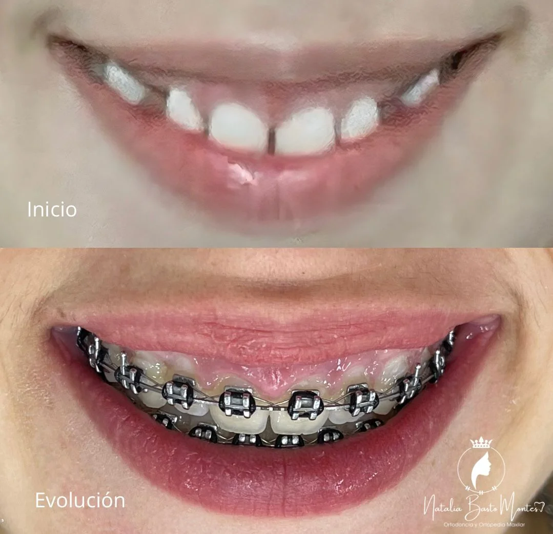 Ortodoncia con Tracción de Caninos Retenidos: Un Caso de Evolución y Progreso