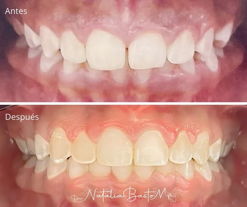 Ortodoncia en Adolescentes: Un Caso de Éxito que Refleja Disciplina y Sonrisas Personalizadas