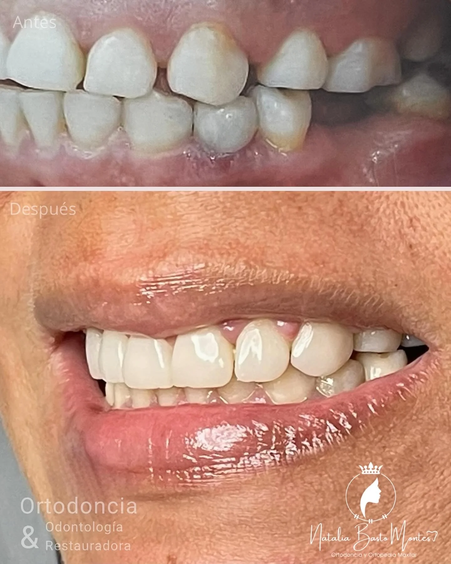 Sonrisa en Armonía: Ortodoncia + Bordes Incisales en Resina de Alta Estética