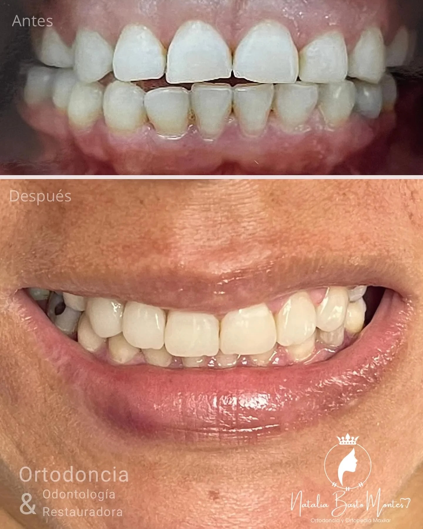 Sonrisa en Armonía: Ortodoncia + Bordes Incisales en Resina de Alta Estética