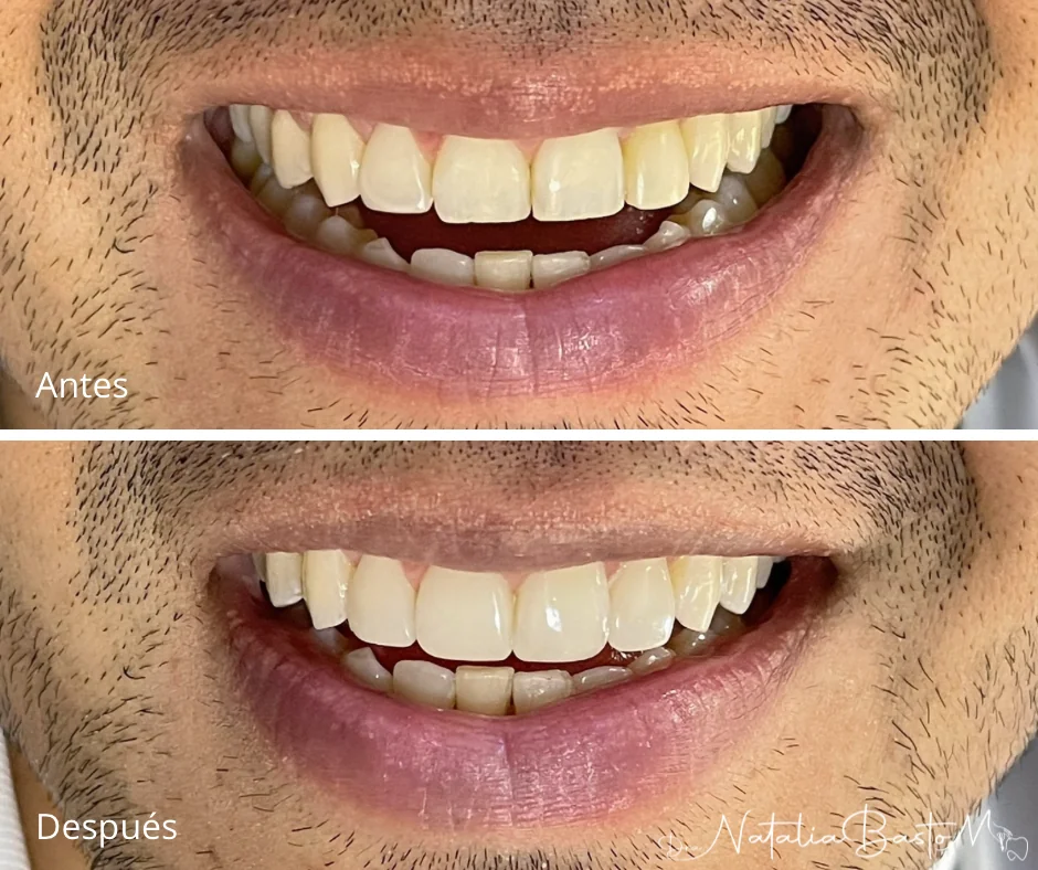 Restauración estética con resina: naturalidad y armonía en la sonrisa