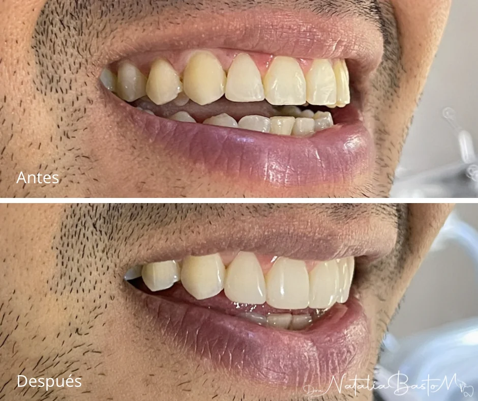 Restauración estética con resina: naturalidad y armonía en la sonrisa