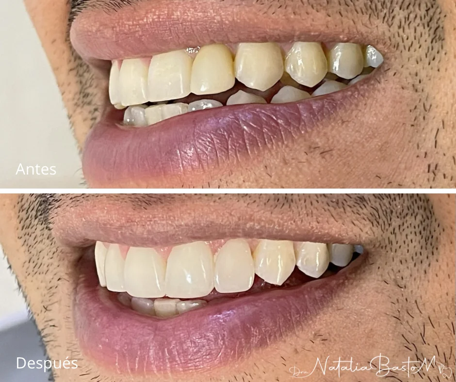 Restauración estética con resina: naturalidad y armonía en la sonrisa