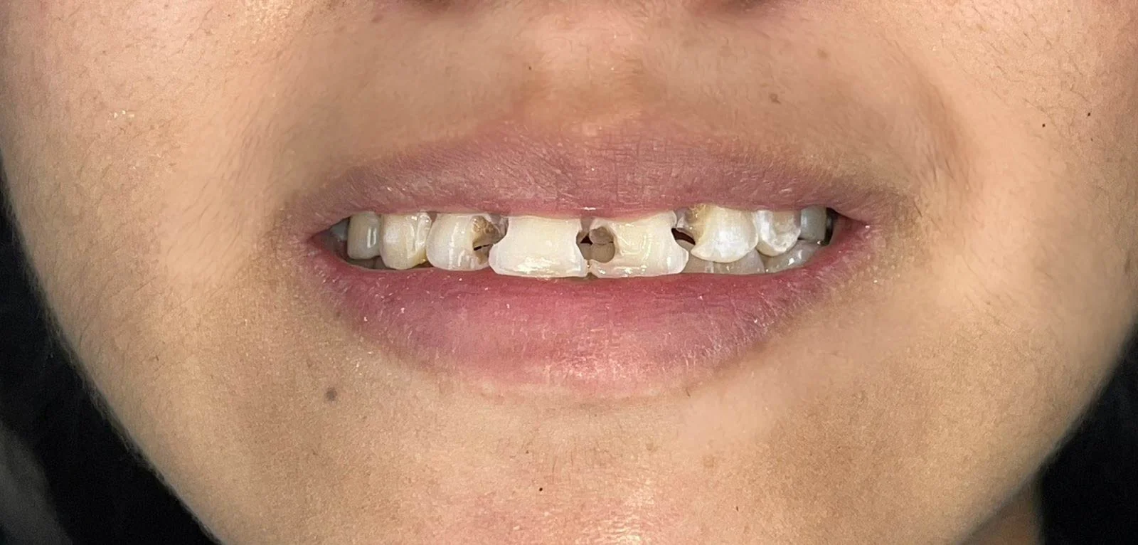 Restauraciones en Resina para una Sonrisa Natural