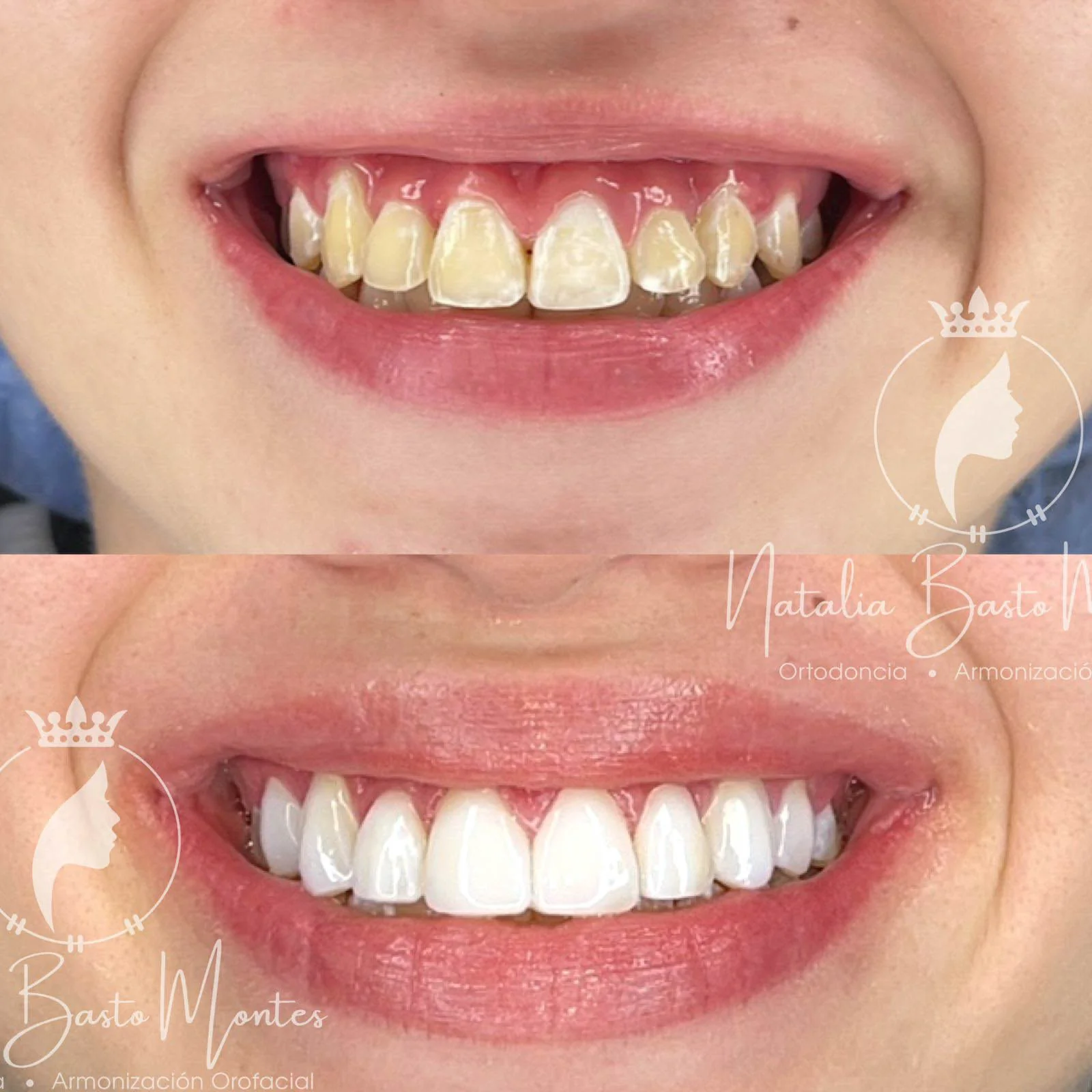 Resultados para una de nuestras pacientes: Ortodoncia y Estética Dental con Carillas de Resina