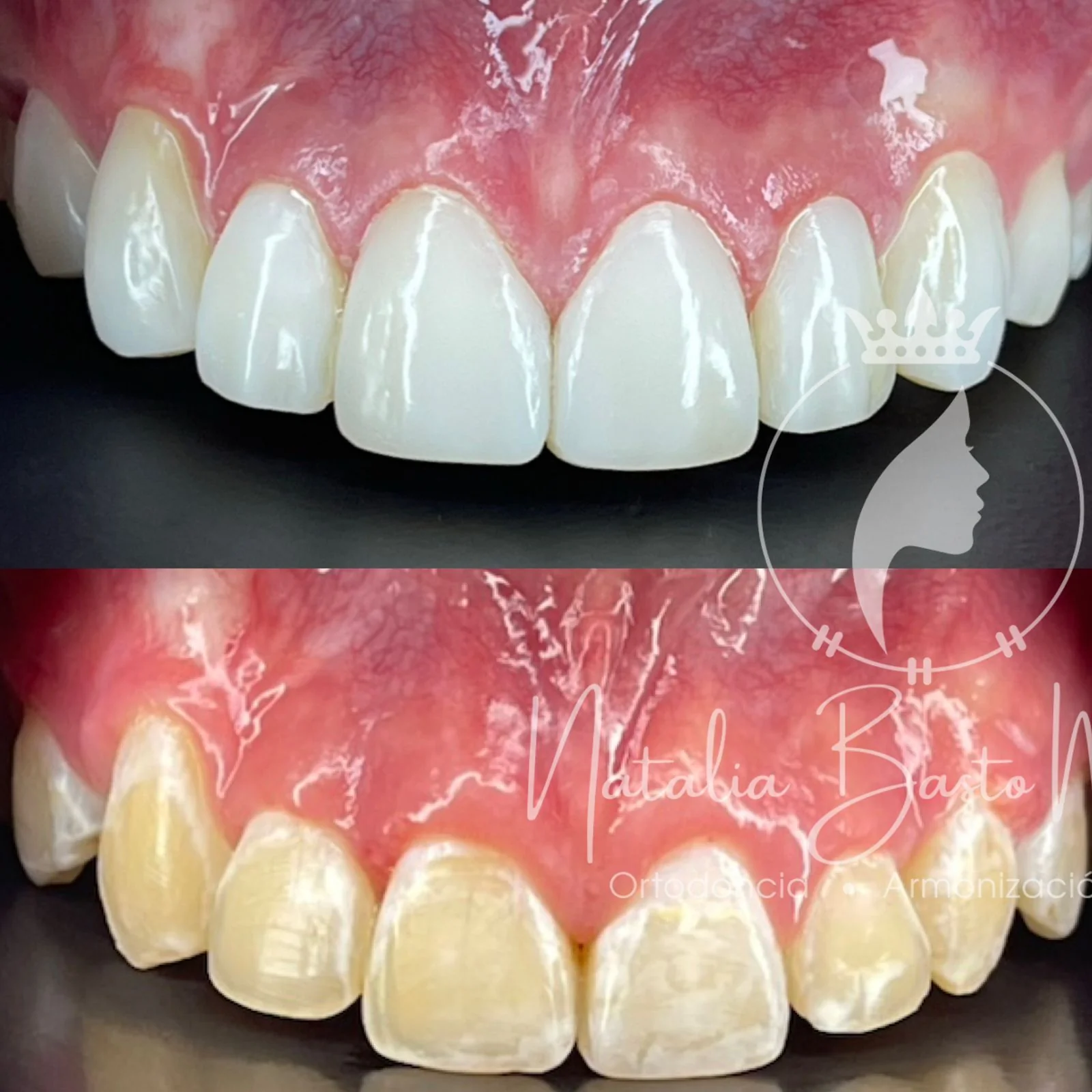 Resultados para una de nuestras pacientes: Ortodoncia y Estética Dental con Carillas de Resina