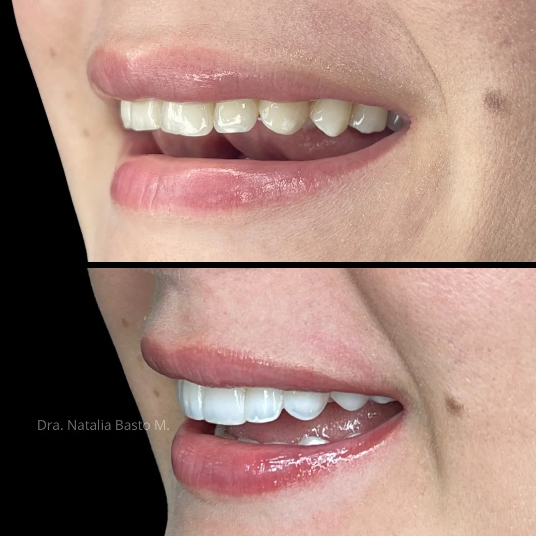 ¡Una sonrisa radiante con resinas de alta estética dental estratificadas!