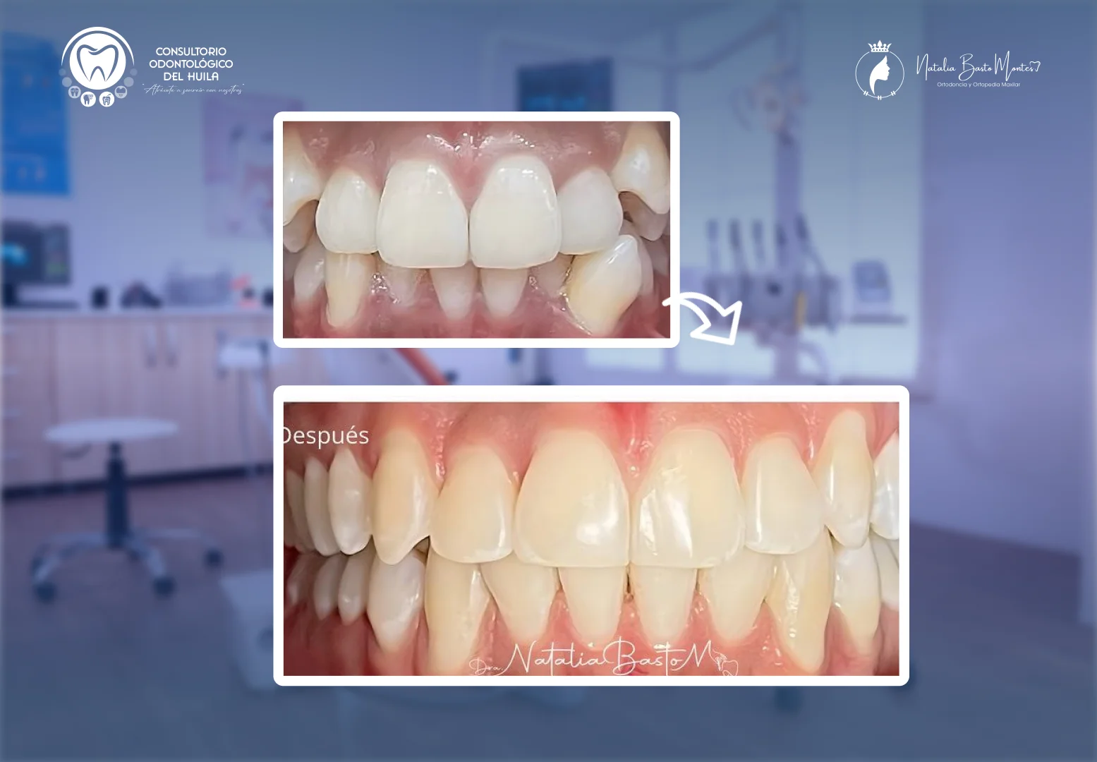 Una Sonrisa Transformada  mediante Brackets MBT: precisión y resultados